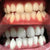 Hvide tænder efter hvidtning med et tandblegningssæt og tandblegningsgel.