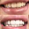 tandblegning Aktivt kul-strips
