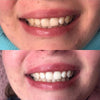PAP+ Tandblegningssæt til tandblegning