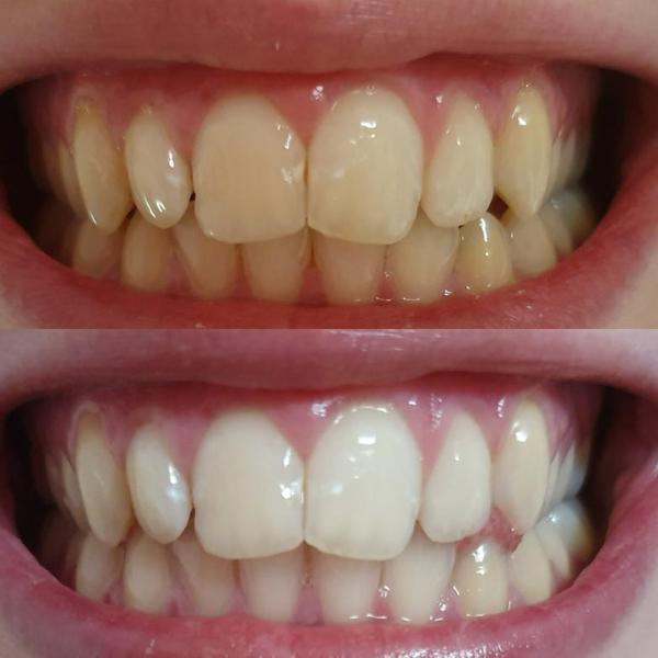 Hvide og gule tænder. Hvide tænder efter tandblegning med tandblegningsgel. Whitening tænder med tandblegning.