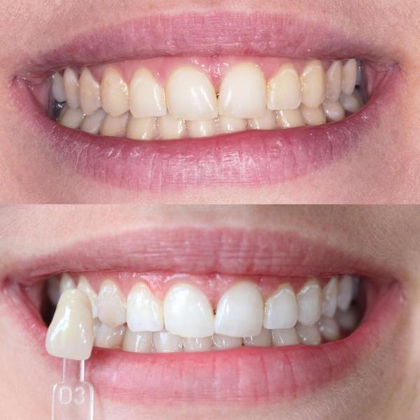 Hvide tænder gennem tandblegning. Billeder af en kvinde efter tandblegning.