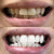 Tandblegning for hvide tænder. Billedet viser et før- og efterbillede af tænderne efter blegning.