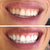 Hvide tænder efter hvidtning med et tandblegningssæt.