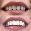 Hvide tænder med Tandblegning Pen - Tandblegning