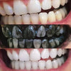 Tandblegning - hvidtning af tænder med aktivt kul