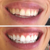 Tandblegningsstrips til hvide tænder