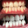 Tandblegning skum til hvidtning af tænder