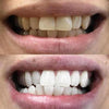 Tænder Whitening Foam - Kosmetisk Tandblegning i hjemmet
