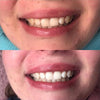 Tandblegning med Diamond Tooth Whitening Gel