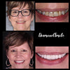 Tandblegning - hvide tænder