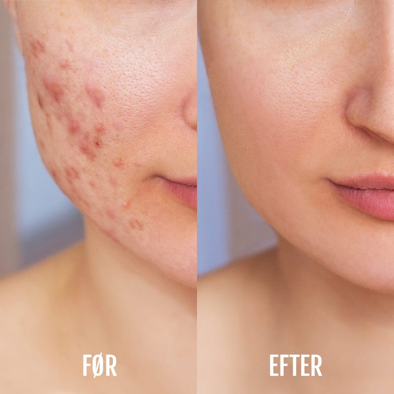 Lysterapi & Akne Enhed DermaClear