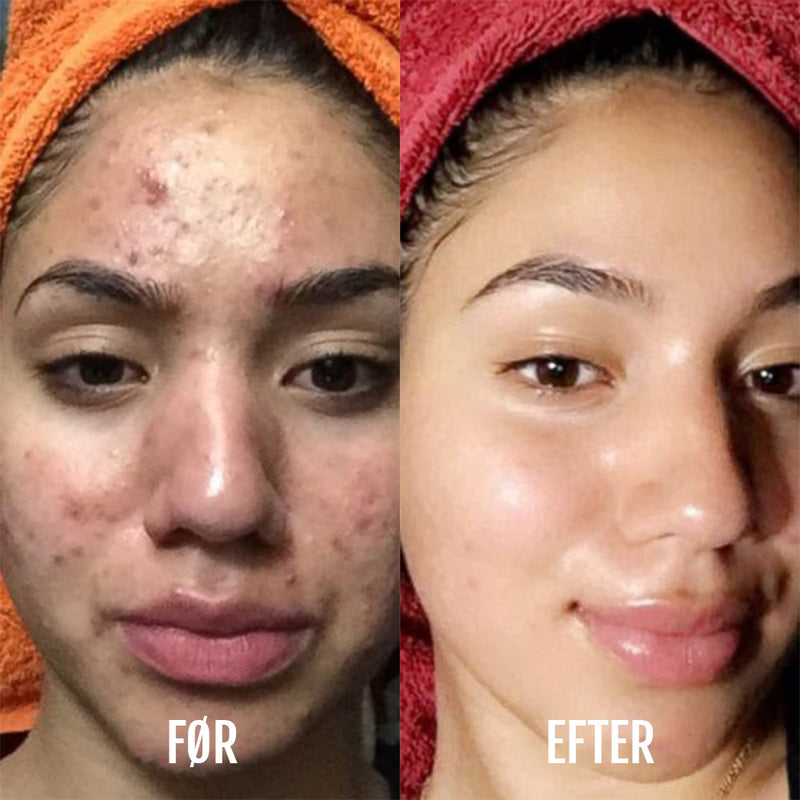 Lysterapi & Akne Enhed DermaClear