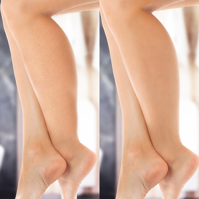 IPL Hårfjerner Lumi