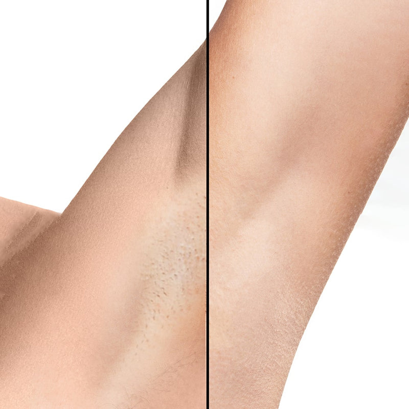 IPL Hårfjerner Lumi